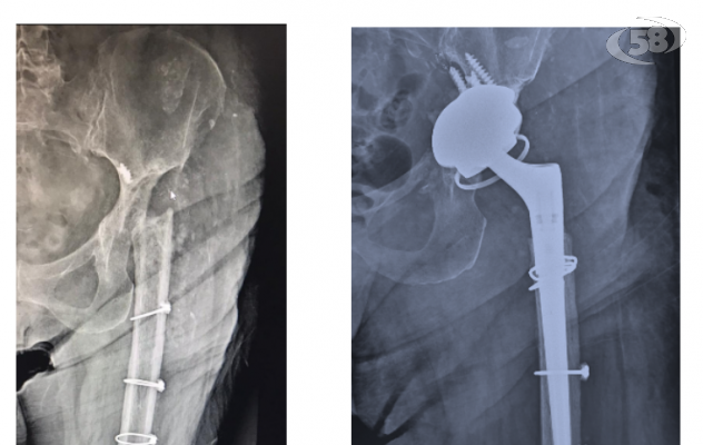 Da 6 anni sulla sedia a rotelle, torna a camminare: chirurgia d'eccellenza al Fatebenefratelli