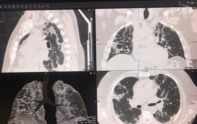 Sindrome post Covid, al Fatebenefratelli tac innovativa per prevenire la fibrosi polmonare