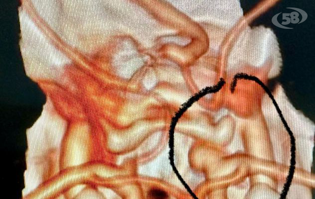 Intervento eccezionale al San Pio, paziente salvata da emorragia da rottura dell’arteria carotide interna 