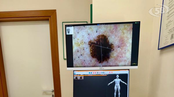 Dermatologia, al San Pio macchinari all'avanguardia: cabina fototerapia e videodermoscopio
