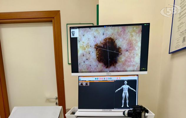 Dermatologia, al San Pio macchinario moderni: cabina di fototerapia e videodermoscopico