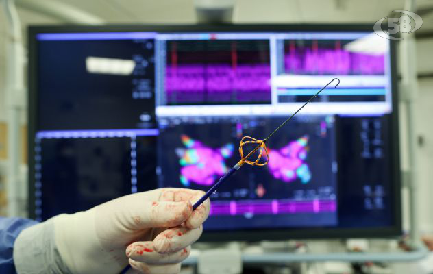 Fibrillazione atriale, al Fatebenefratelli eseguite due ablazioni a campo pulsato